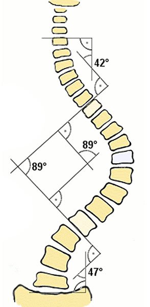 scoliosis screening