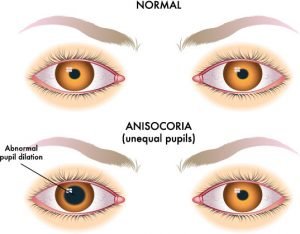 causes of acute unequal pupil size